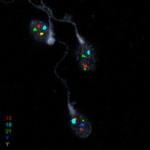 Sperm Chromosome Aneuploidy